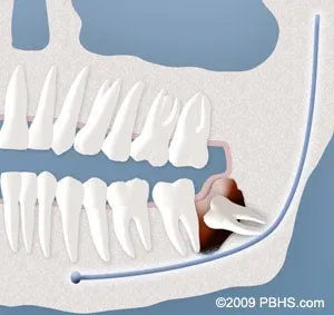wisdom tooth infection